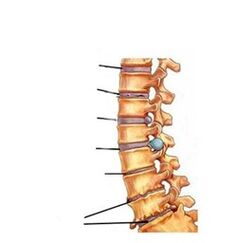 Az osteochondrosis fejlődési szakaszai