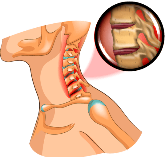 osteochondrosis a nyakban