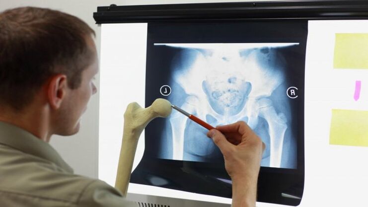 Az orvos röntgenfelvételt vizsgál csípőízületi arthrosisra